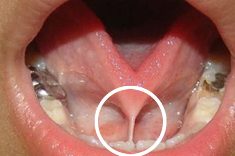 Cirugía de Frenillo Lingual: Solución para la Anquiloglosia Lingual