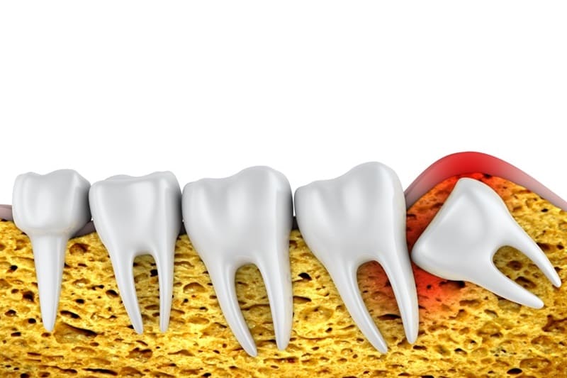 Cirugía de Terceros Molares: Soluciones para las Muelas del Juicio Impactadas