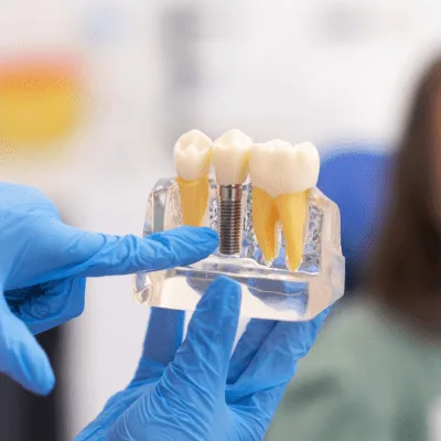 Guía integral para el tratamiento de dientes fracturados en CDMX