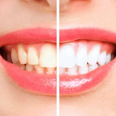 Tratamiento y diagnóstico integral para dientes manchados en CDMX