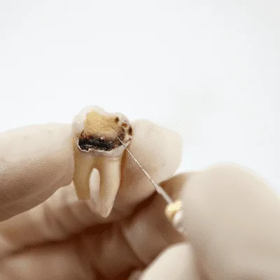 Abordaje clínico de las infecciones dentales en CDMX